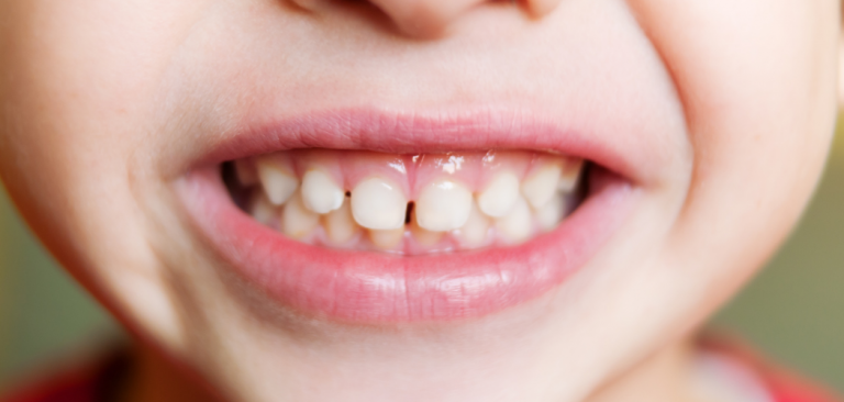 Why Do Kids Wear Silver Teeth? Understand Its Advantages